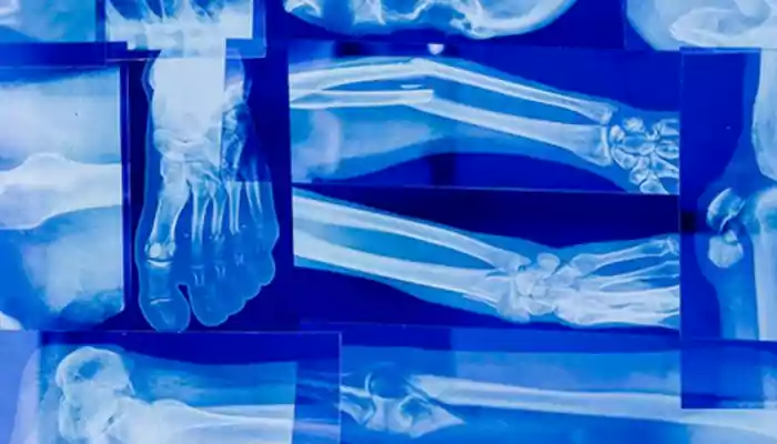 Signs that indicate your bones are weak